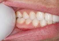 Right side of smile, teeth pulled back