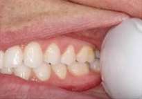 left side of smile, cheek pulled back
