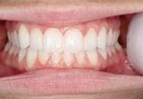 Smile straight on with cheeks pulled back